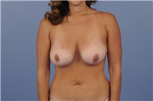 Body Contouring Before Photo by Trent Douglas, MD; Knoxville, TN - Case 31416
