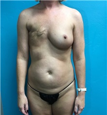 Breast Reconstruction Before Photo by Anureet Bajaj, MD; ,  - Case 31696