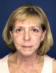 Facelift After Photo by Mark Markarian, MD, MSPH, FACS; Wellesley, MA - Case 31825