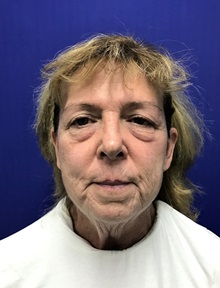 Facelift Before Photo by Mark Markarian, MD, MSPH, FACS; Wellesley, MA - Case 31825