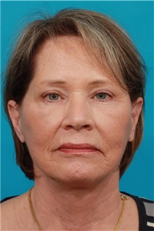 Facelift After Photo by Michael Bogdan, MD, MBA, FACS; Grapevine, TX - Case 31848