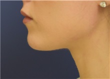 Chin Augmentation After Photo by Richard Reish, MD, FACS; New York, NY - Case 32663
