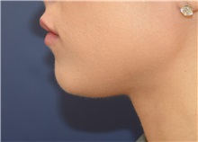 Chin Augmentation Before Photo by Richard Reish, MD, FACS; New York, NY - Case 32663