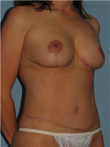 Body Contouring After Photo by Paul Vanek, MD, FACS; Concord, OH - Case 32755