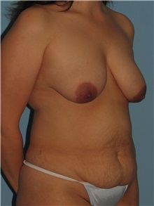 Body Contouring Before Photo by Paul Vanek, MD, FACS; Concord, OH - Case 32755