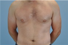 Male Breast Reduction After Photo by Paul Vanek, MD, FACS; Concord, OH - Case 32774
