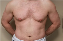 Male Breast Reduction Before Photo by Paul Vanek, MD, FACS; Concord, OH - Case 32774