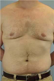 Male Breast Reduction After Photo by Paul Vanek, MD, FACS; Concord, OH - Case 32776