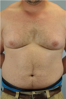 Male Breast Reduction Before Photo by Paul Vanek, MD, FACS; Concord, OH - Case 32776