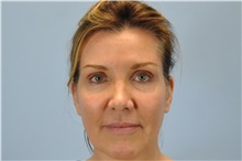 Botulinum Toxin After Photo by Paul Vanek, MD, FACS; Concord, OH - Case 32791