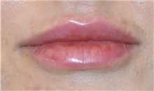 Lip Augmentation/Enhancement After Photo by Richard Reish, MD, FACS; New York, NY - Case 33054