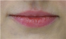 Lip Augmentation/Enhancement Before Photo by Richard Reish, MD, FACS; New York, NY - Case 33054