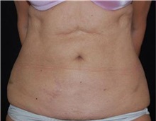 Liposuction After Photo by Sean Doherty, MD; Chestnut Hill, MA - Case 33412