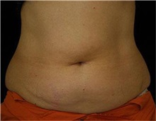 Liposuction Before Photo by Sean Doherty, MD; Chestnut Hill, MA - Case 33412