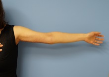 Arm Lift After Photo by William Lao, MD; New York, NY - Case 33754