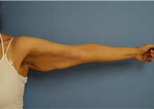 Arm Lift Before Photo by William Lao, MD; New York, NY - Case 33754