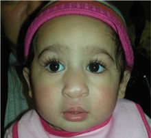 Cleft Lip and Palate Repair After Photo by Rachel Ruotolo, MD; Garden City, NY - Case 34073