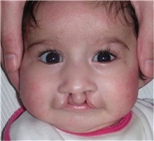 Cleft Lip and Palate Repair Before Photo by Rachel Ruotolo, MD; Garden City, NY - Case 34073