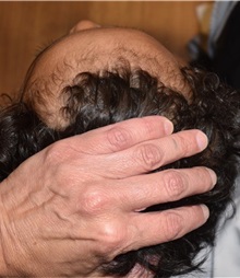 Craniosynostosis After Photo by Rachel Ruotolo, MD; Garden City, NY - Case 34159