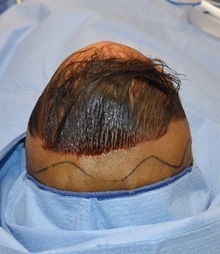 Craniosynostosis Before Photo by Rachel Ruotolo, MD; Garden City, NY - Case 34159