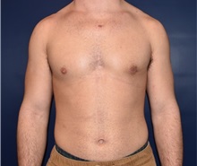 Male Breast Reduction After Photo by Rachel Ruotolo, MD; Garden City, NY - Case 34209