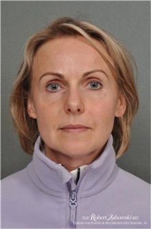 Botulinum Toxin After Photo by Robert Zubowski, MD; ,  - Case 34550