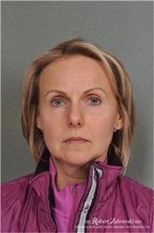 Botulinum Toxin Before Photo by Robert Zubowski, MD; ,  - Case 34550