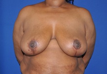Breast Reduction After Photo by Jerry Weiger Chang, MD, FACS; Flushing, NY - Case 35033