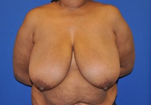 Breast Reduction Before Photo by Jerry Weiger Chang, MD, FACS; Flushing, NY - Case 35033