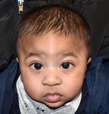 Craniosynostosis Before Photo by Rachel Ruotolo, MD; Garden City, NY - Case 35077