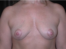 Breast Lift After Photo by Frederick Lukash, MD, FACS, FAAP; North Hills, NY - Case 35144