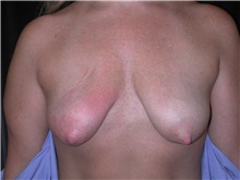 Breast Lift Before Photo by Frederick Lukash, MD, FACS, FAAP; North Hills, NY - Case 35144