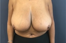 Breast Reduction Before Photo by Brian Pinsky, MD, FACS; Babylon, NY - Case 35483