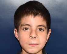 Cleft Lip and Palate Repair After Photo by Rachel Ruotolo, MD; Garden City, NY - Case 35531