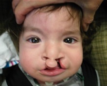 Cleft Lip and Palate Repair Before Photo by Rachel Ruotolo, MD; Garden City, NY - Case 35531