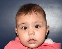 Craniosynostosis After Photo by Rachel Ruotolo, MD; Garden City, NY - Case 35541