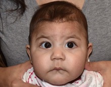 Craniosynostosis Before Photo by Rachel Ruotolo, MD; Garden City, NY - Case 35541