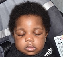 Cleft Lip and Palate Repair After Photo by Rachel Ruotolo, MD; Garden City, NY - Case 35581