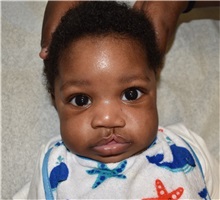 Cleft Lip and Palate Repair Before Photo by Rachel Ruotolo, MD; Garden City, NY - Case 35581