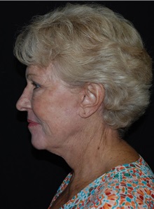 Facelift After Photo by Robert Kessler, MD; Corona Del Mar, CA - Case 35783