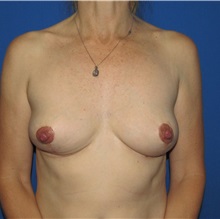 Breast Implant Removal After Photo by Trent Douglas, MD; Knoxville, TN - Case 35920