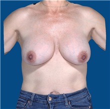 Breast Implant Removal Before Photo by Trent Douglas, MD; Knoxville, TN - Case 35920