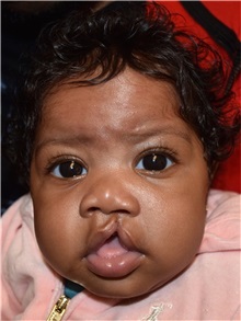 Cleft Lip and Palate Repair Before Photo by Rachel Ruotolo, MD; Garden City, NY - Case 36070
