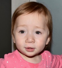 Cleft Lip and Palate Repair After Photo by Rachel Ruotolo, MD; Garden City, NY - Case 36170