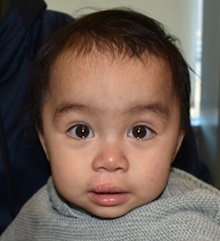 Cleft Lip and Palate Repair After Photo by Rachel Ruotolo, MD; Garden City, NY - Case 36180