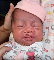 Cleft Lip and Palate Repair Before Photo by Rachel Ruotolo, MD; Garden City, NY - Case 36180
