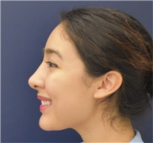 Rhinoplasty After Photo by Richard Reish, MD, FACS; New York, NY - Case 36254