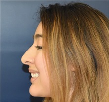 Rhinoplasty Before Photo by Richard Reish, MD, FACS; New York, NY - Case 36254