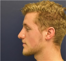 Rhinoplasty After Photo by Richard Reish, MD, FACS; New York, NY - Case 36267