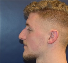 Rhinoplasty Before Photo by Richard Reish, MD, FACS; New York, NY - Case 36267